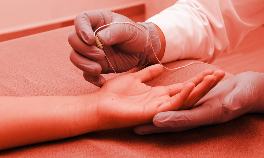 intraoperative neuromonitoring